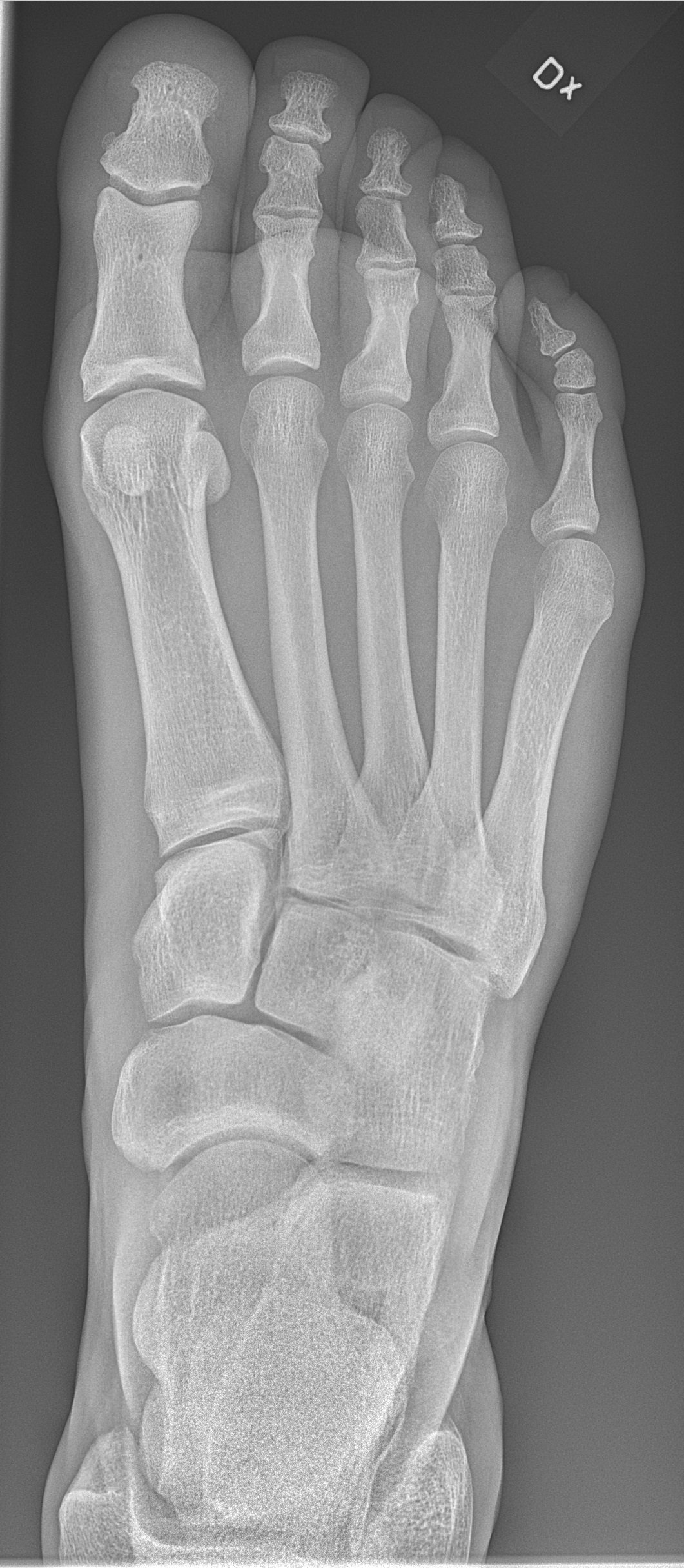 Radiograph of the right foot